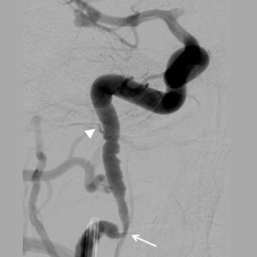 Cerebral Catheters - Image 2