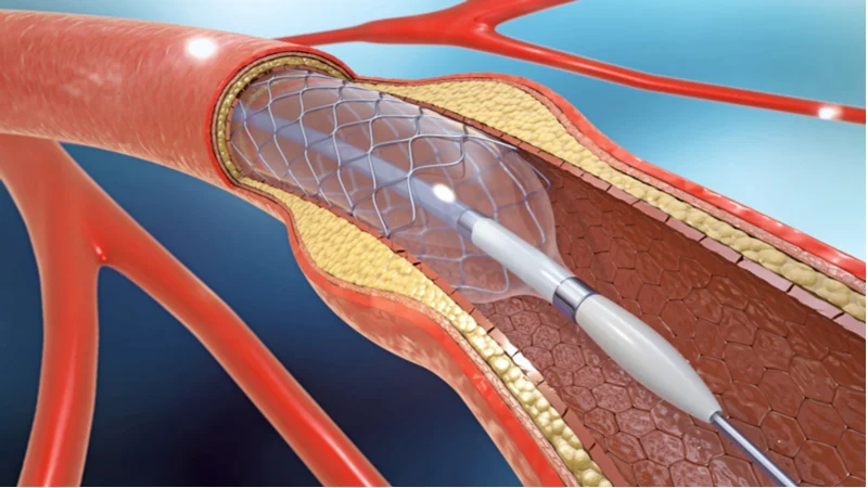 BIOTRONIK 2 Orsiro Coronary Stent Drug Eluting Stent Biotronik - Image 3